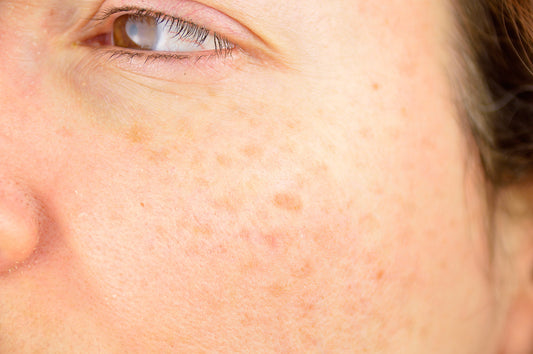The Complete Guide to Treating Pigmentation in Australia